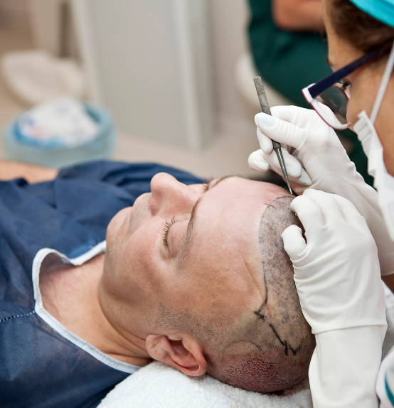 homme greffe de cheveux